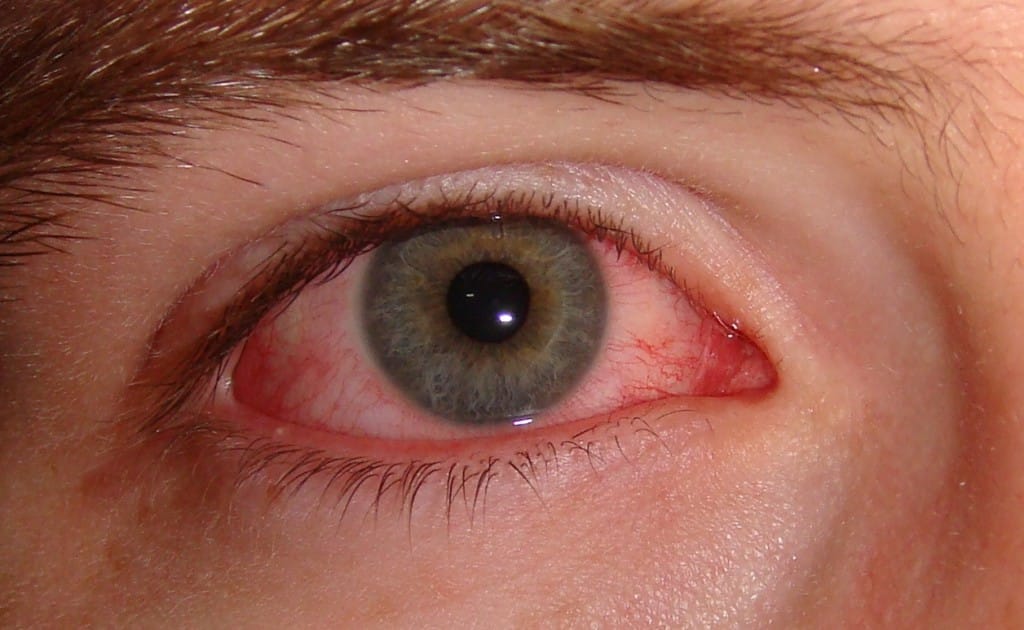 Vnetje oči (konjunktivitis)