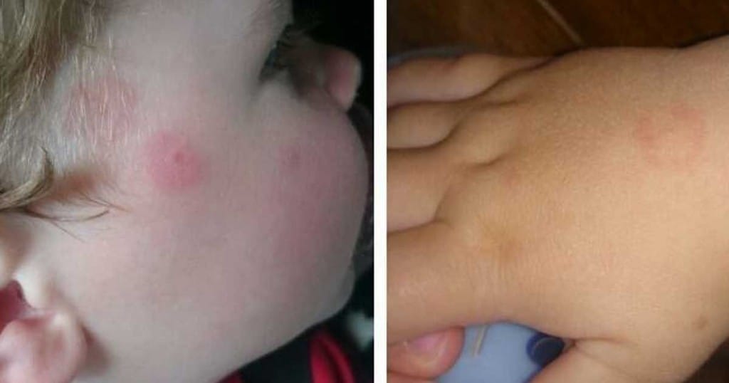 Borelioza ali lymska bolezen - nevarnost preži tudi na otroke Borelioza ali lymska bolezen - nevarnost preži tudi na otroke