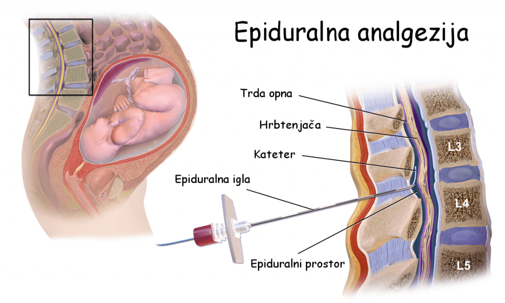 Uporaba epiduralne analgezije med porodom - koristi in nevarnosti Uporaba epiduralne analgezije med porodom - koristi in nevarnosti