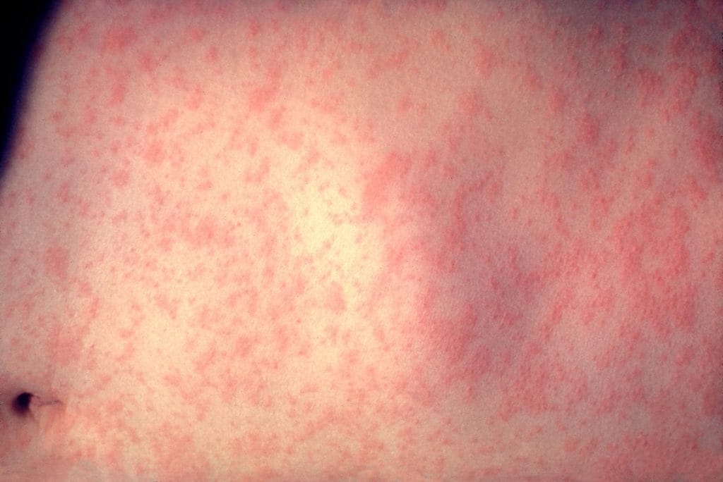 Rdečke pri otrocih - vzroki, simptomi in zdravljenje Rdečke pri otrocih - vzroki, simptomi in zdravljenje