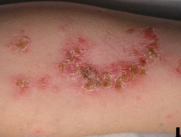 Impetigo - najpogostejša okužba kože pri otrocih Impetigo - najpogostejša okužba kože pri otrocih