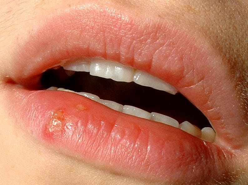 Herpes na ustnicah - simptomi in zdravljenje